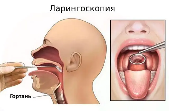 Diagnóza laryngitidy