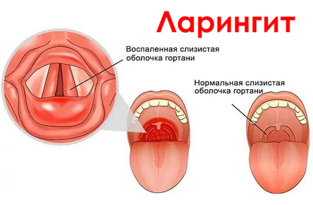 Laryngitis