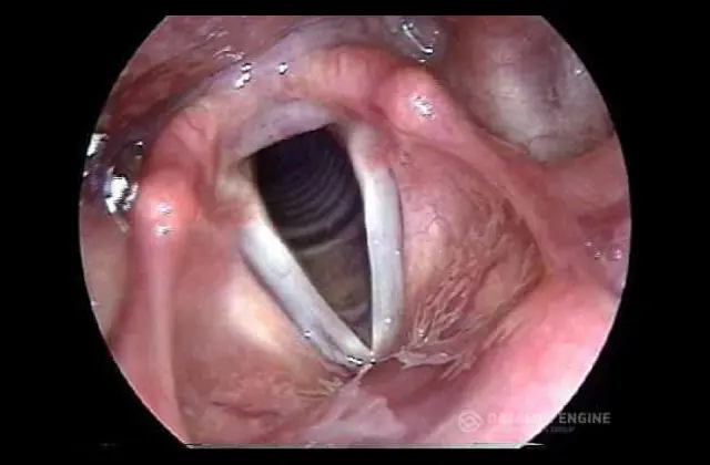 Acute laryngitis