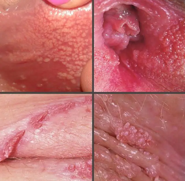 What do papillomas on the labia look like?