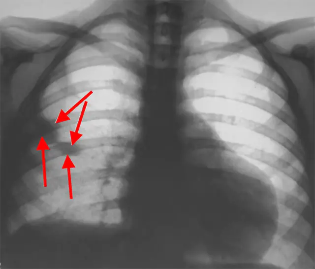 Діагностики легеневої емболії – рентгенографія грудної клітки.