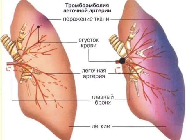 тромбоемболія легеневої артерії