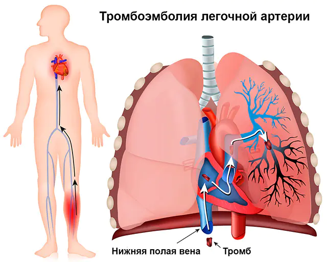 симптоми емболії легеневої артерії