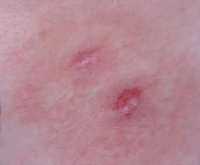 Result of papilloma removal with Malavit