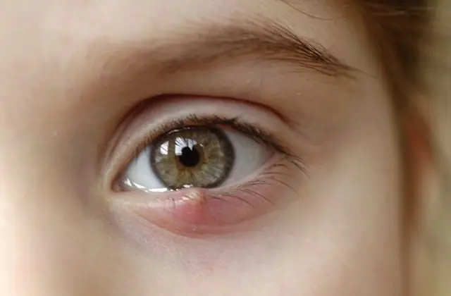 Meibomitis des unteren Augenlids