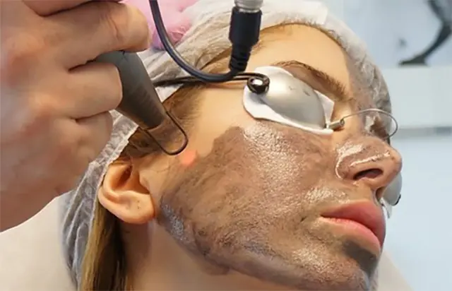 peeling della pelle del viso con laser al carbonio