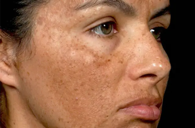 Melasma im Gesicht einer Frau