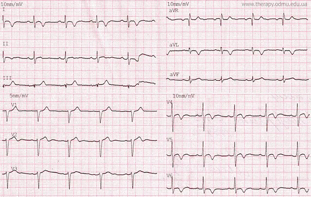 ECG of a patient with viral myocarditis