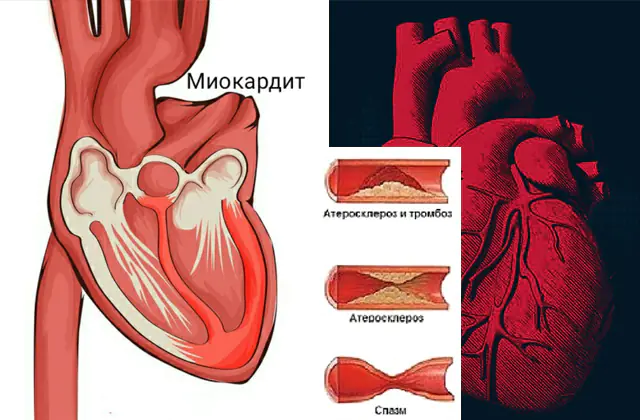 Miocardite