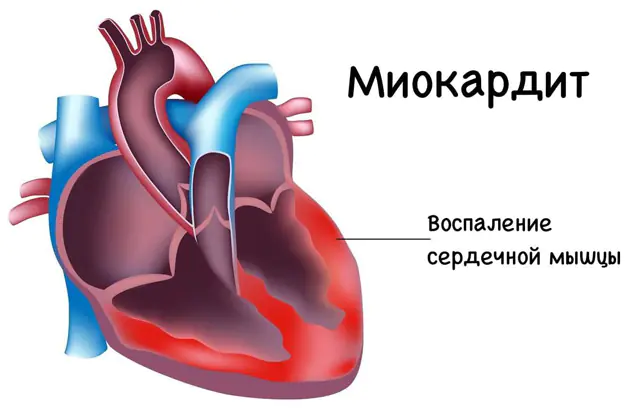 Kalp kası iltihabı