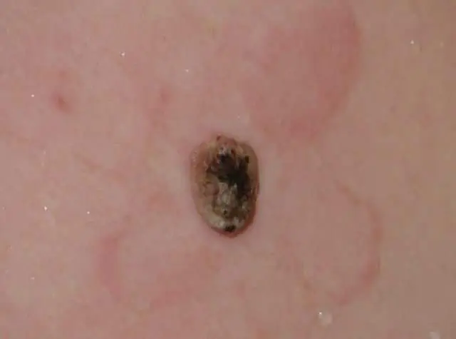 Il papilloma degenera in un tumore maligno