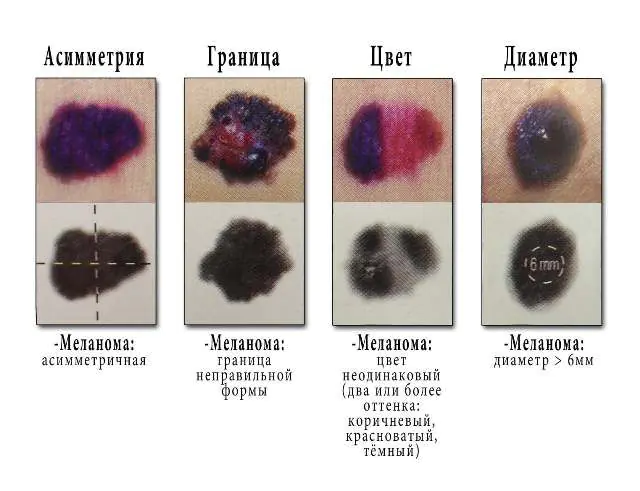 Signos de melanoma