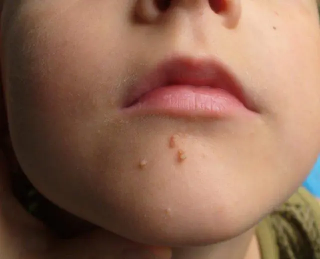 Infection of a child with HPV