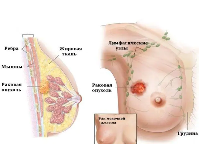 Καρκίνος του μαστού