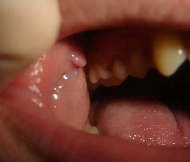 Papillooma suussa