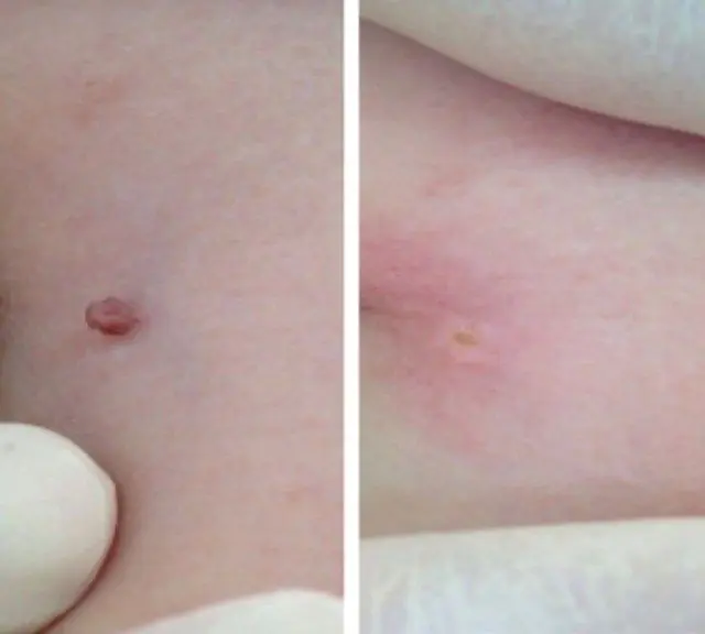 Result of papilloma removal with thread