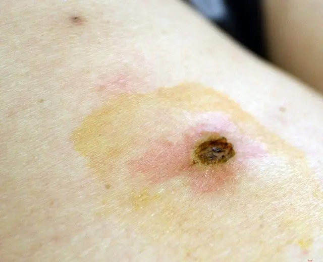 Skorpe på huden efter fjernelse af papilloma