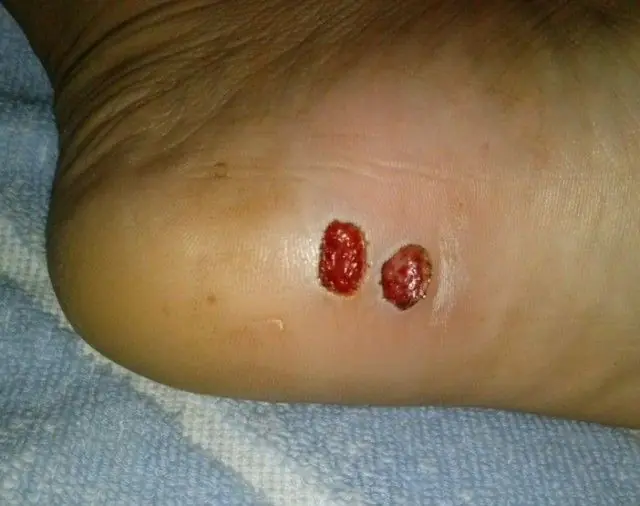 Wounds after removal of papillomas