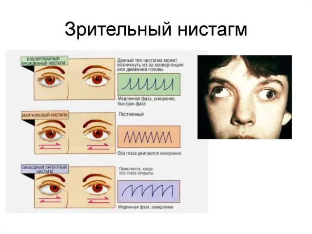 Tipos de nistagmo ocular