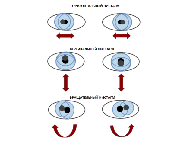 Rodzaje oczopląsu oka