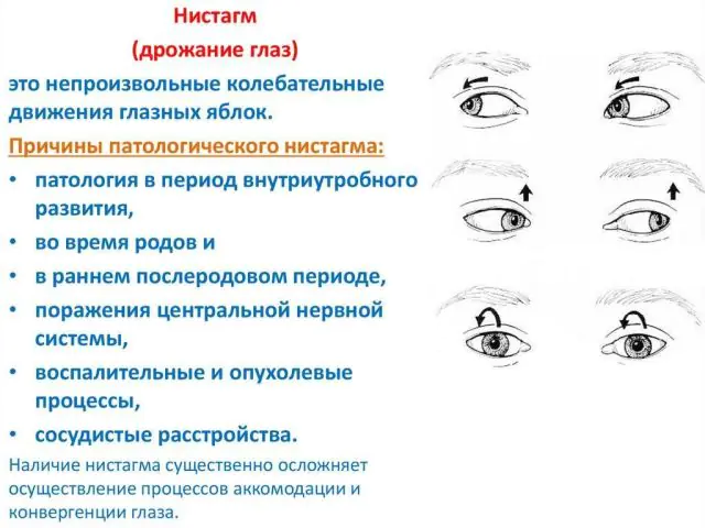Causas do nistagmo ocular