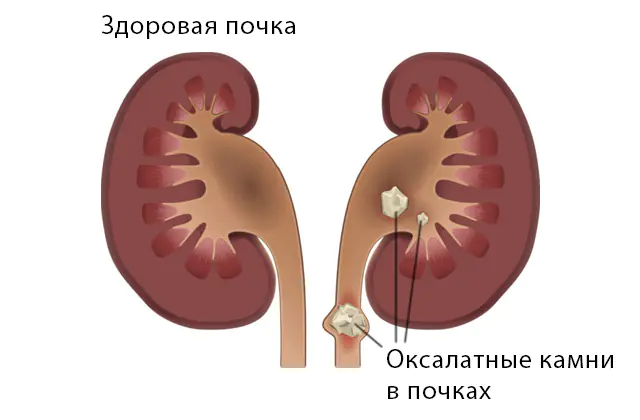 オキサラ尿症 - 腎臓結石