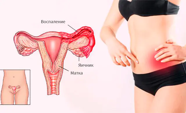 Ooforitis o inflamación de los ovarios.