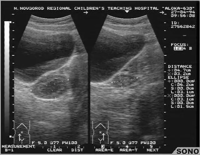 Ultrasound - diagnosis of oophoritis