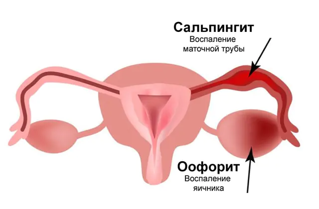 Ooforit - kadınlarda yumurtalıkların iltihabı