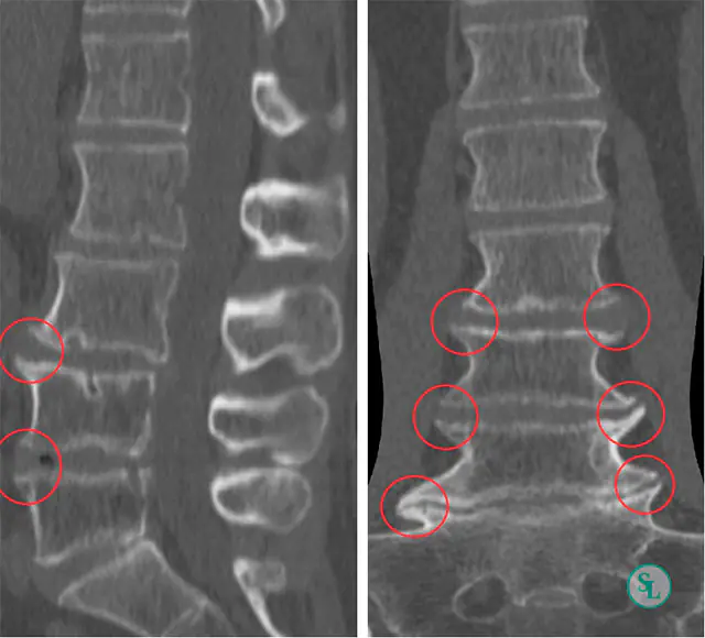 Radiography - a method for diagnosing osteophytes