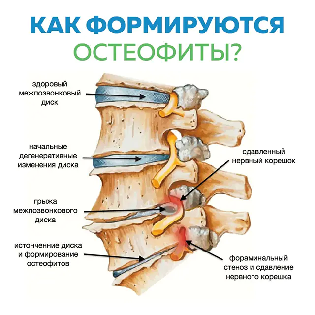 Ostéophytes de la colonne vertébrale