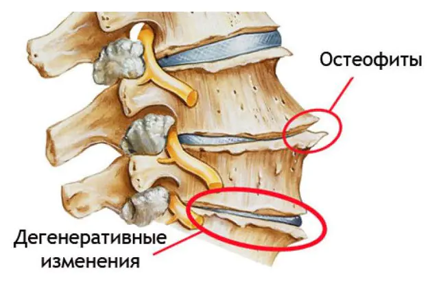 Osteofytter i rygsøjlen