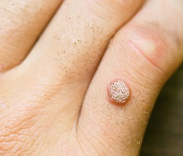 Was führt dazu, dass Papillome an den Fingern wachsen?