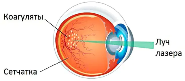 Retina dekolmanı üçün lazer terapiyası