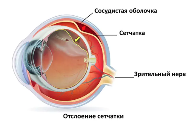 descolamento da retina
