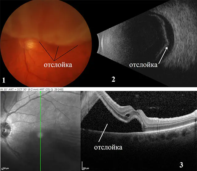 Diagnosi del distacco della retina