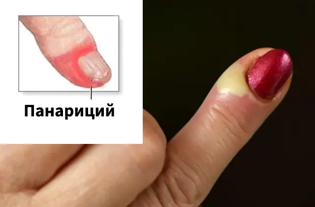Panaritium on a finger