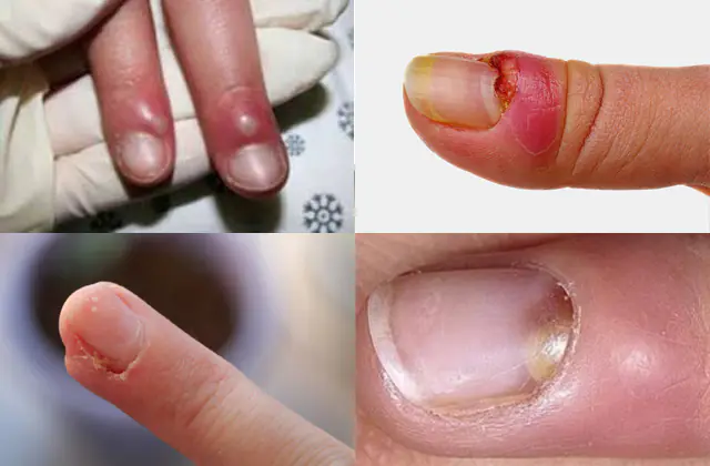 panaritium on a finger