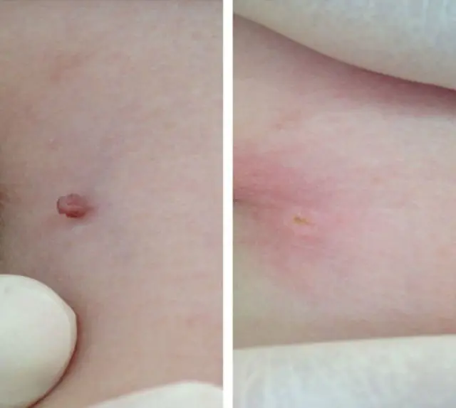 Results of using Papiderm for papillomas