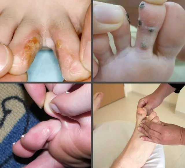 What do papillomas between the toes look like?