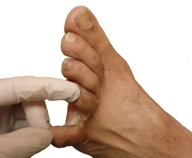 Papilom mezi prsty na nohou