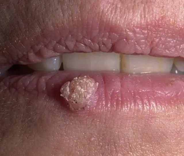 Hvordan ser papilloma ud på læben?