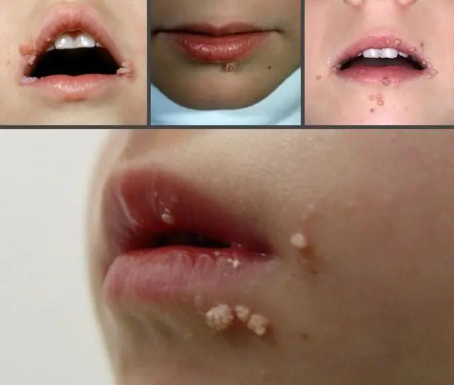 Papilomas en los labios en niños.
