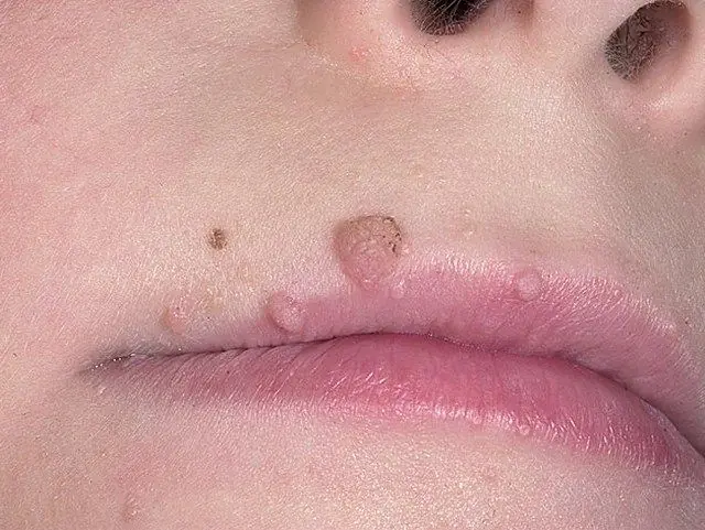 Papillomlar bir çocuğun dudaklarında neye benziyor?