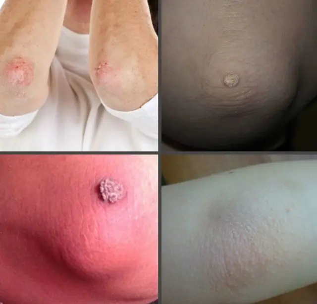 What do papillomas on the elbows look like?