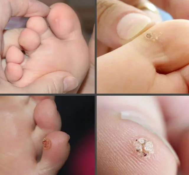 어린이의 발가락 유두종은 어떻게 생겼습니까?
