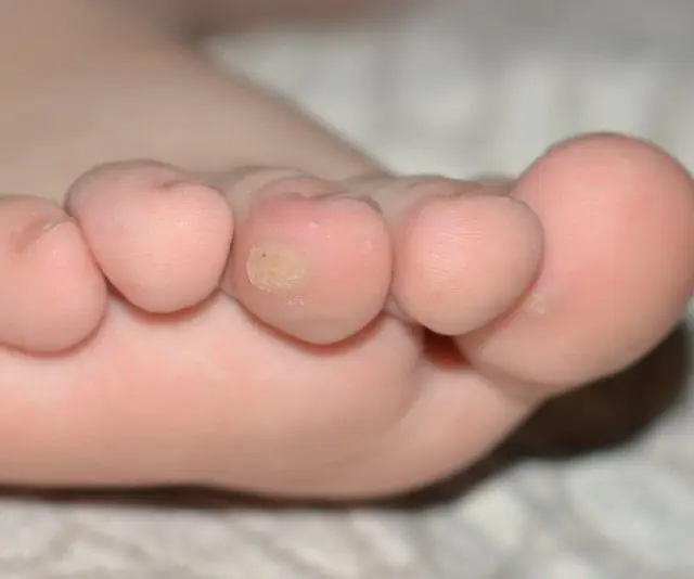 Papiloma en el dedo del pie