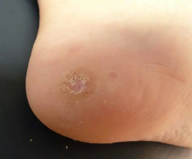 Papilloma on the heel