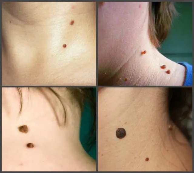 Papillomas on the neck in children