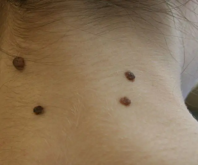 What do papillomas look like on a child’s neck?